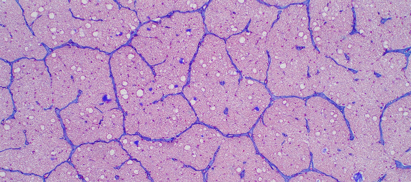 Thumbnail for Brain fog: explained